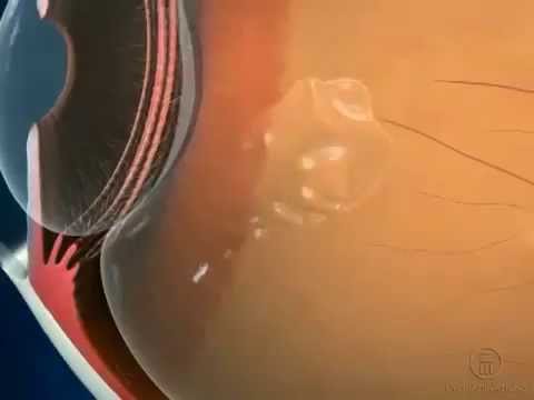 Видео о препарате Луцентис Ранибизумаб (Лаксолан аналог) р-р для инъекций внутриглазных 10мг/мл 0,23мл №1